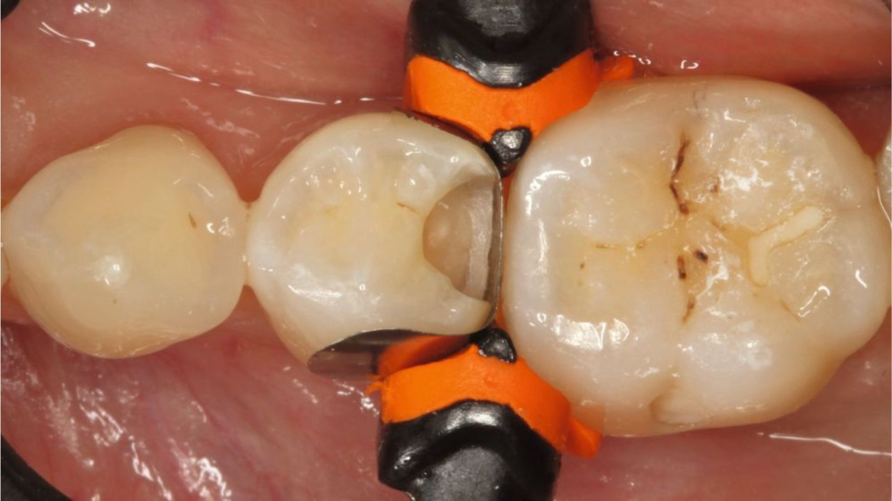 Prévention et traitement des caries proximales pour une bonne san — free download